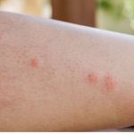 5 plantas medicinales para aliviar las picaduras de insectos