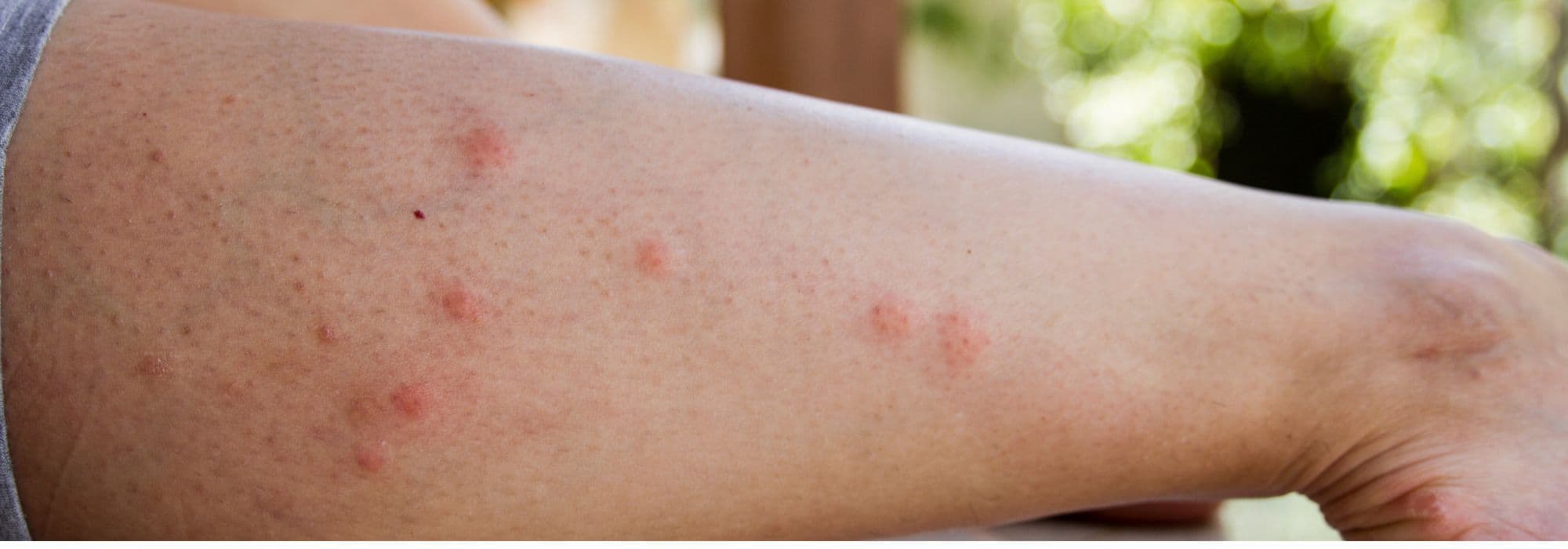 5 plantas medicinales para aliviar las picaduras de insectos